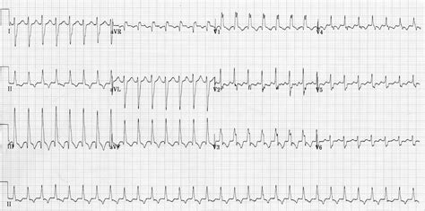 Idiopathic Fascicular Left Ventricular Tachycardia .